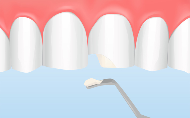 ダイレクトボンディングって？